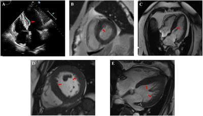 Clinical Characteristics for the Improvement of Cushing's Syndrome Complicated With Cardiomyopathy After Treatment With a Literature Review